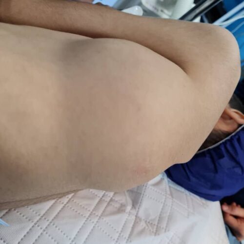 توده‌ی سمت چپ جدار قفسه‌ سینه در کودک ۸ ساله که با عمل جراحی برداشته شد